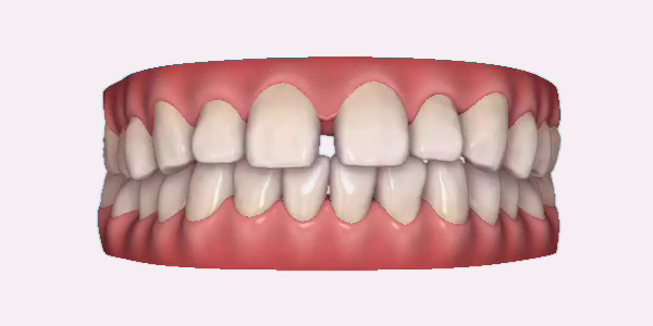 Gapped Teeth